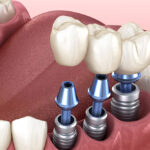 Dental Implant
