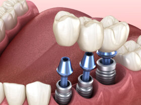 Dental Implant