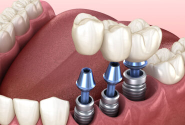 Dental Implant
