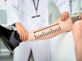 How Long Do You Stay in Istanbul for Leg Lengthening? The Honest Answer Is a Phase, Not a Number