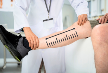 How Long Do You Stay in Istanbul for Leg Lengthening? The Honest Answer Is a Phase, Not a Number